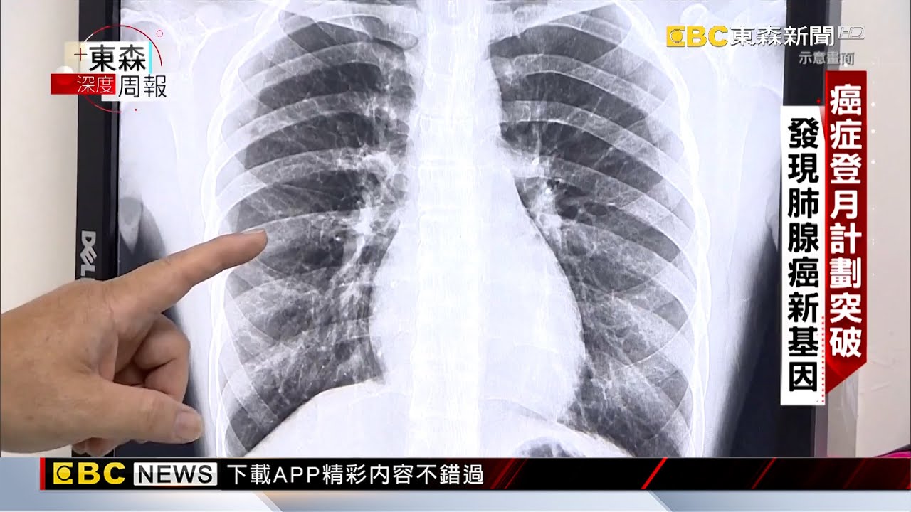 【東森深度周報】中研院重大發現 女性特殊基因誘發肺腺癌 范繼文 楊尚仁 黃書葦報導 @newsebc